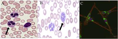 Neutrophil Evolution and Their Diseases in Humans